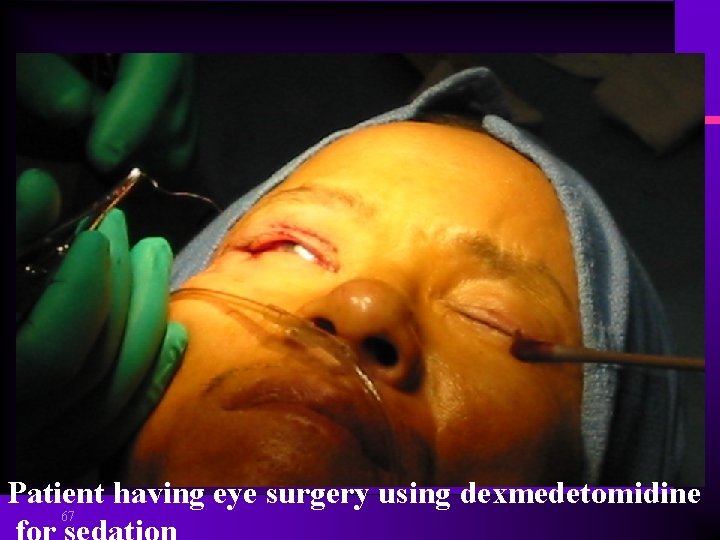 Patient having eye surgery using dexmedetomidine 67 