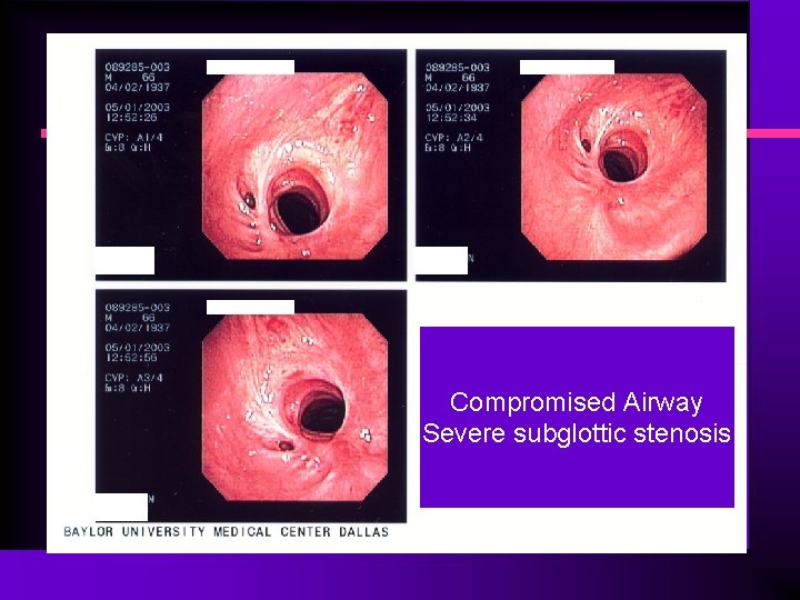 Compromised Airway Severe subglottic stenosis 