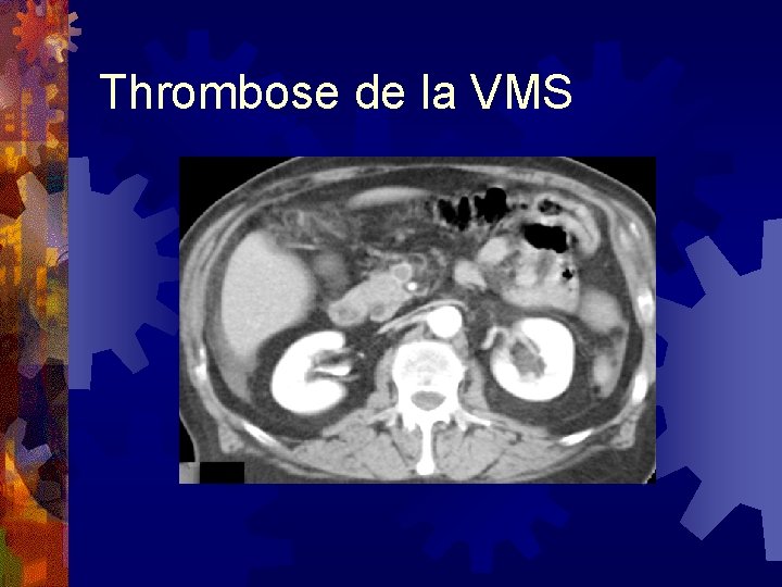 Thrombose de la VMS 