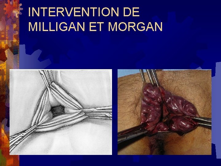 INTERVENTION DE MILLIGAN ET MORGAN 