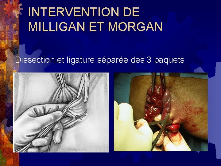 INTERVENTION DE MILLIGAN ET MORGAN Dissection et ligature séparée des 3 paquets 