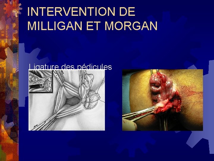 INTERVENTION DE MILLIGAN ET MORGAN Ligature des pédicules 