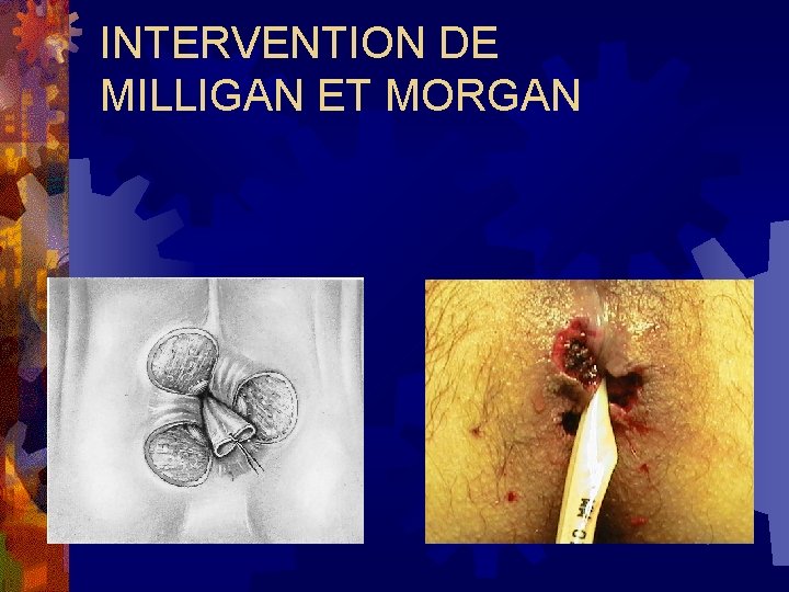 INTERVENTION DE MILLIGAN ET MORGAN 