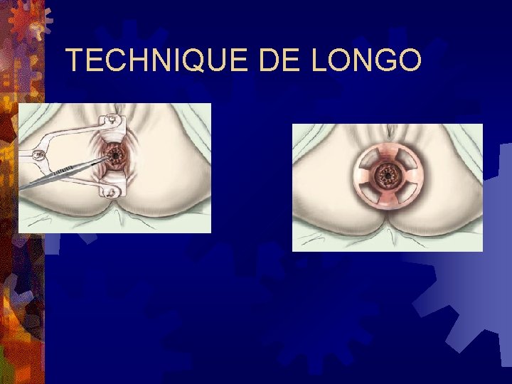 TECHNIQUE DE LONGO 