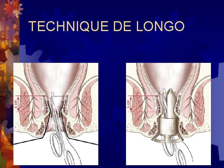 TECHNIQUE DE LONGO 