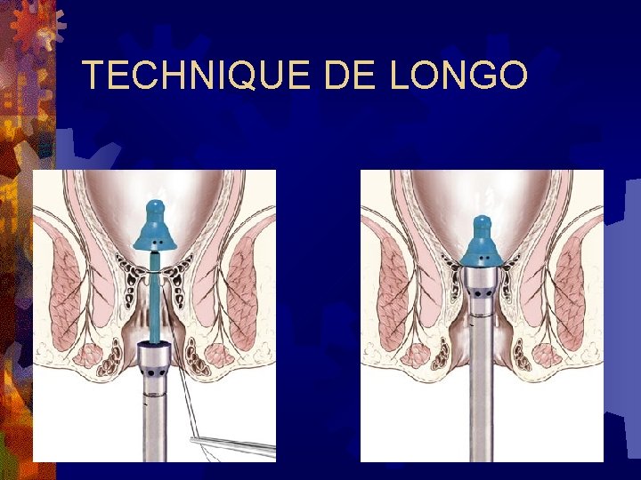 TECHNIQUE DE LONGO 