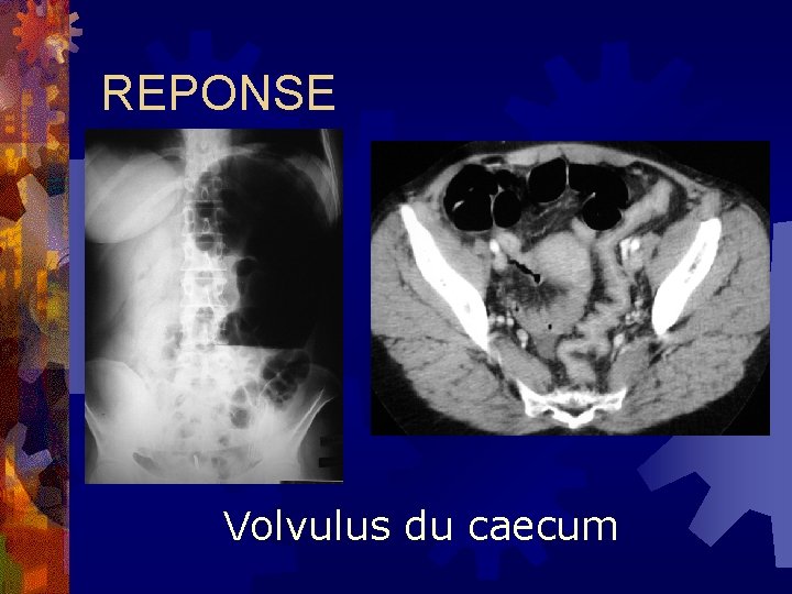 REPONSE Volvulus du caecum 