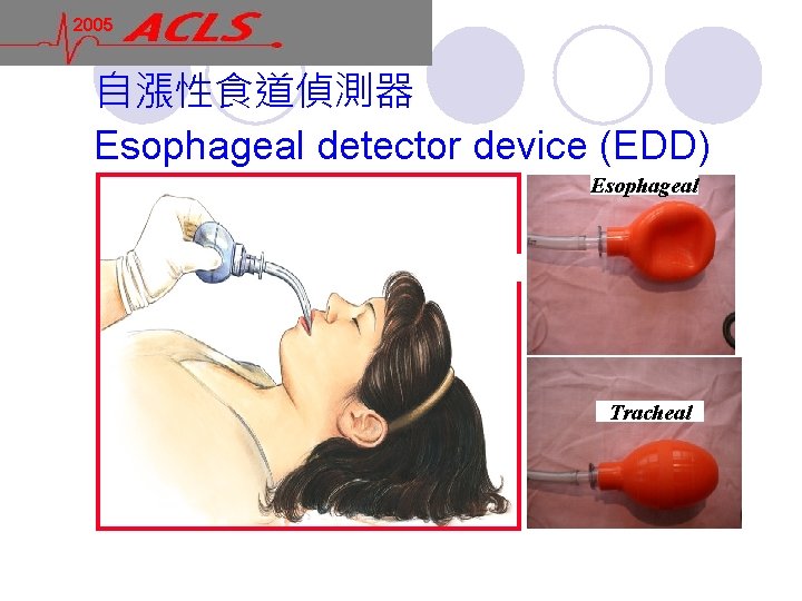 2005 自漲性食道偵測器 Esophageal detector device (EDD) Esophageal Tracheal 