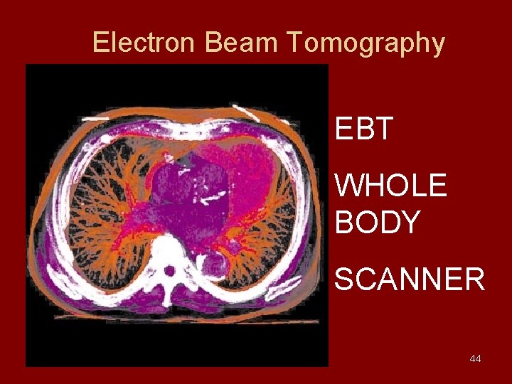 Electron Beam Tomography EBT WHOLE BODY SCANNER 44 