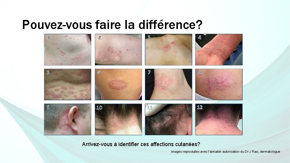 Pouvez-vous faire la différence? Arrivez-vous à identifier ces affections cutanées? Images reproduites avec l’aimable