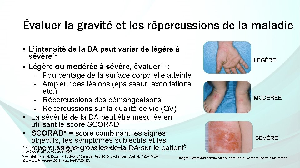 Évaluer la gravité et les répercussions de la maladie • L’intensité de la DA