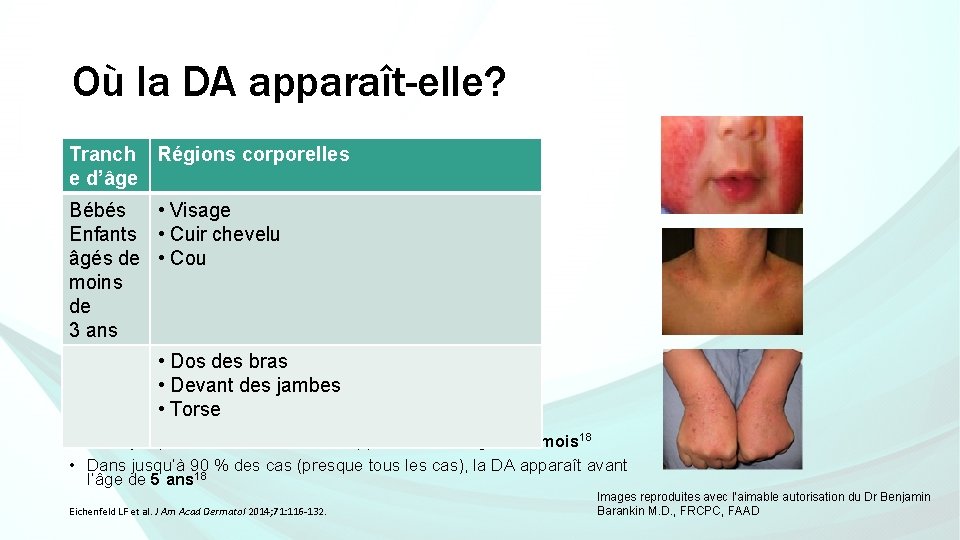 Où la DA apparaît-elle? Tranch Régions corporelles e d’âge Bébés • Visage Enfants •