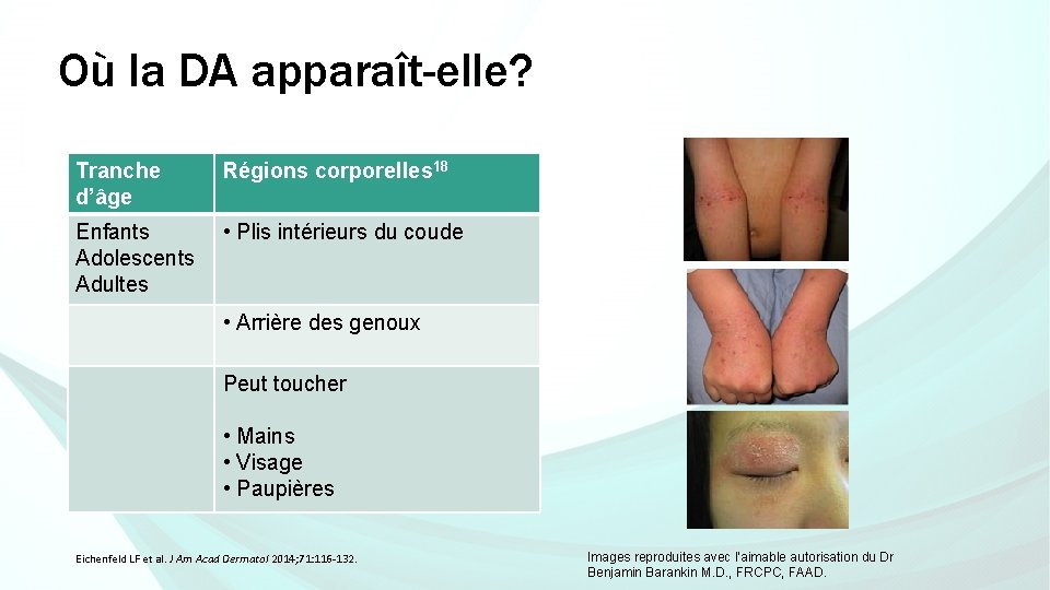 Où la DA apparaît-elle? Tranche d’âge Régions corporelles 18 Enfants Adolescents Adultes • Plis Où la DA apparaît-elle? Tranche d’âge Régions corporelles 18 Enfants Adolescents Adultes • Plis