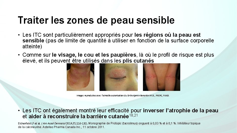 Traiter les zones de peau sensible • Les ITC sont particulièrement appropriés pour les