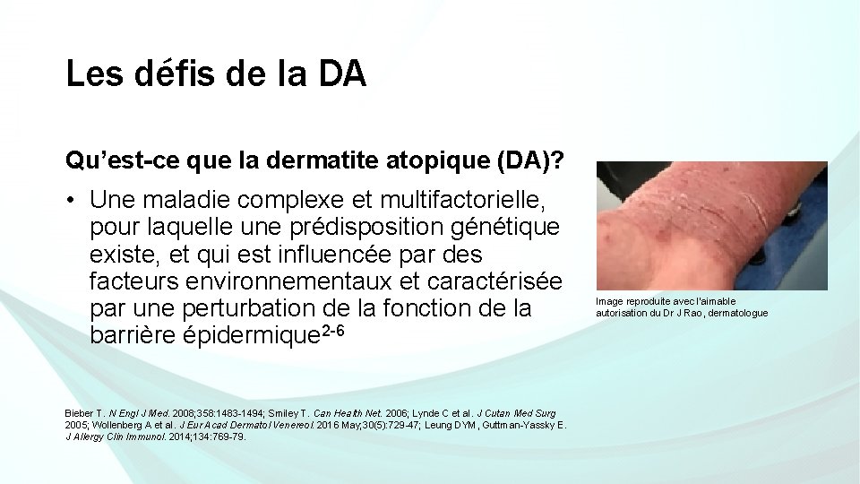 Les défis de la DA Qu’est-ce que la dermatite atopique (DA)? • Une maladie