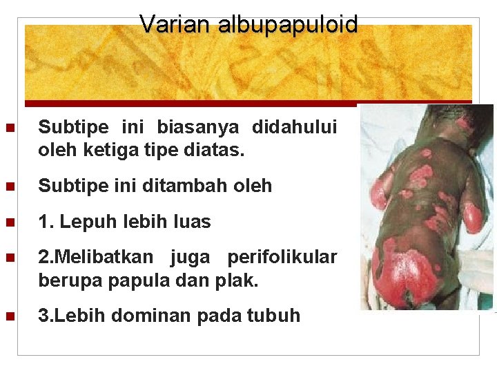 Varian albupapuloid Subtipe ini biasanya didahului oleh ketiga tipe diatas. Subtipe ini ditambah oleh