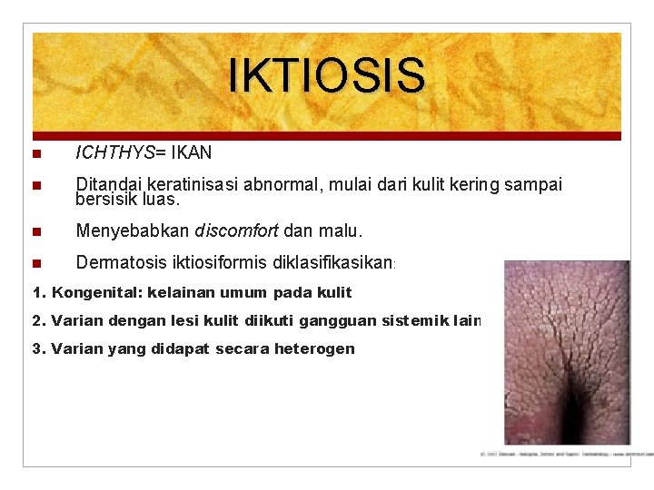 IKTIOSIS ICHTHYS= IKAN Ditandai keratinisasi abnormal, mulai dari kulit kering sampai bersisik luas. Menyebabkan