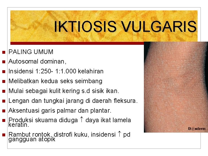 IKTIOSIS VULGARIS PALING UMUM Autosomal dominan, Insidensi 1: 250 - 1: 1. 000 kelahiran