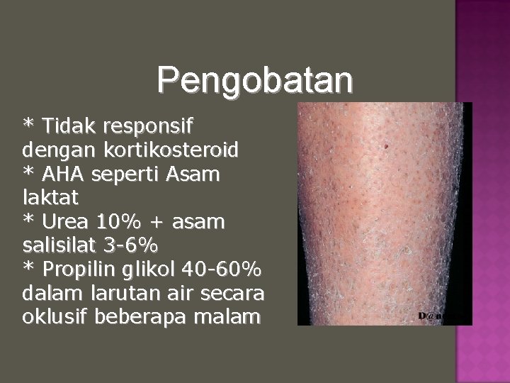 Pengobatan * Tidak responsif dengan kortikosteroid * AHA seperti Asam laktat * Urea 10%