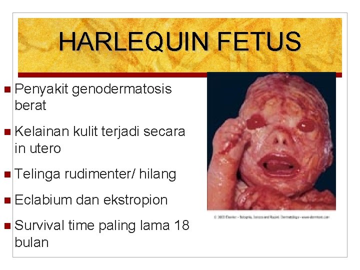 HARLEQUIN FETUS Penyakit genodermatosis berat Kelainan kulit terjadi secara in utero Telinga rudimenter/ hilang