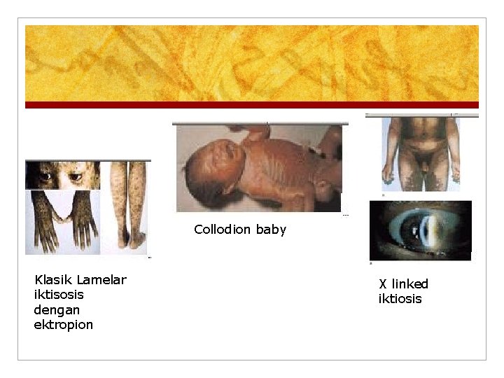 Collodion baby Klasik Lamelar iktisosis dengan ektropion X linked iktiosis 