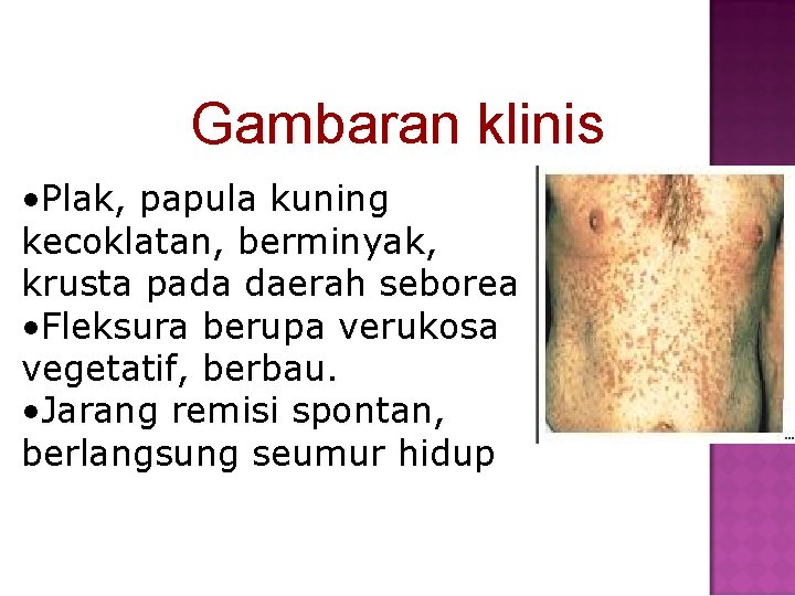 Gambaran klinis • Plak, papula kuning kecoklatan, berminyak, krusta pada daerah seborea • Fleksura