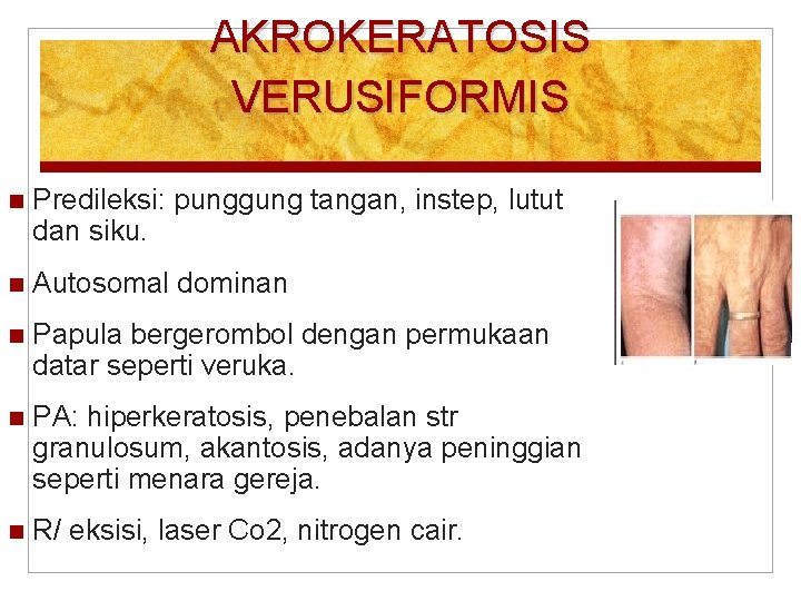 AKROKERATOSIS VERUSIFORMIS Predileksi: punggung tangan, instep, lutut dan siku. Autosomal dominan Papula bergerombol dengan