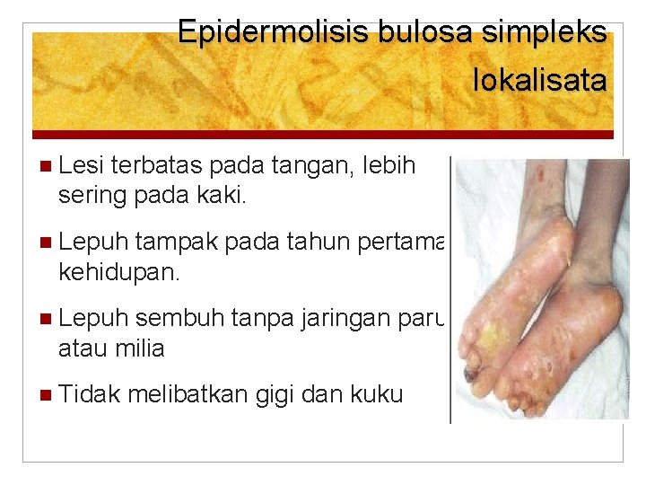 Epidermolisis bulosa simpleks lokalisata Lesi terbatas pada tangan, lebih sering pada kaki. Lepuh tampak