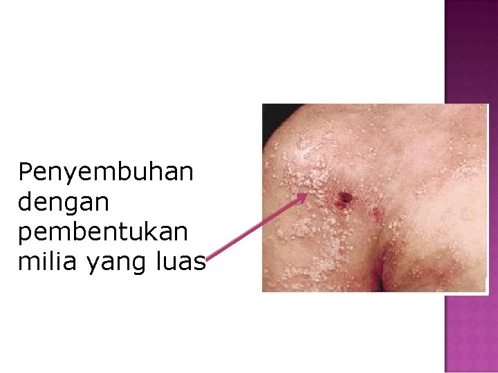 Penyembuhan dengan pembentukan milia yang luas 