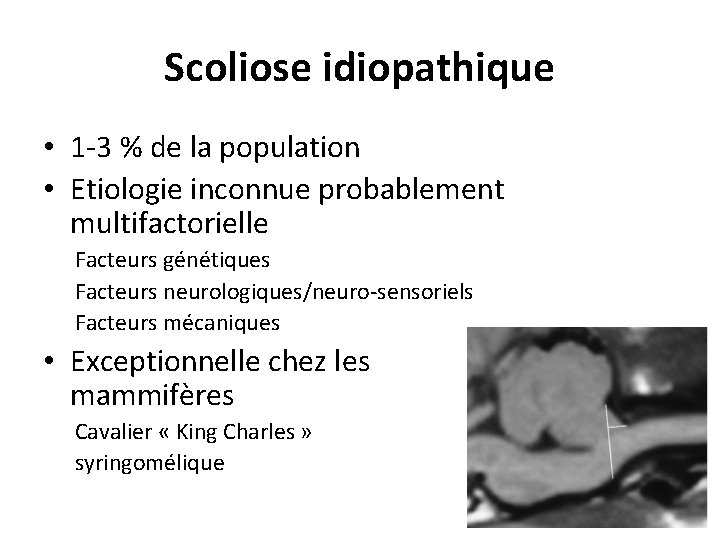 Scoliose idiopathique • 1 -3 % de la population • Etiologie inconnue probablement multifactorielle Scoliose idiopathique • 1 -3 % de la population • Etiologie inconnue probablement multifactorielle