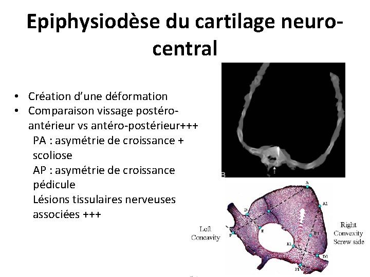 Epiphysiodèse du cartilage neurocentral • Création d’une déformation • Comparaison vissage postéroantérieur vs antéro-postérieur+++ Epiphysiodèse du cartilage neurocentral • Création d’une déformation • Comparaison vissage postéroantérieur vs antéro-postérieur+++