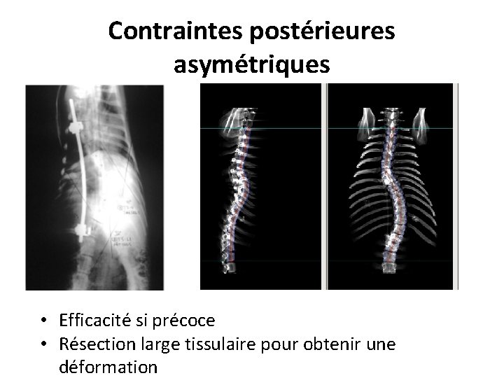 Contraintes postérieures asymétriques • Efficacité si précoce • Résection large tissulaire pour obtenir une Contraintes postérieures asymétriques • Efficacité si précoce • Résection large tissulaire pour obtenir une