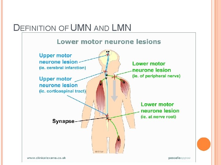 DEFINITION OF UMN AND LMN DEFINITION OF UMN AND LMN