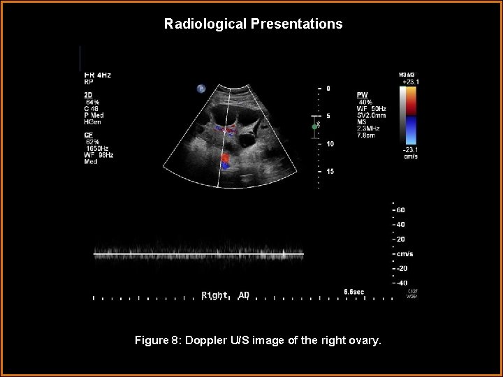 Radiological Presentations Figure 8: Doppler U/S image of the right ovary. 