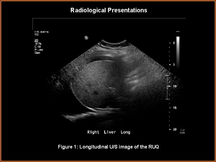 Radiological Presentations Figure 1: Longitudinal U/S image of the RUQL 