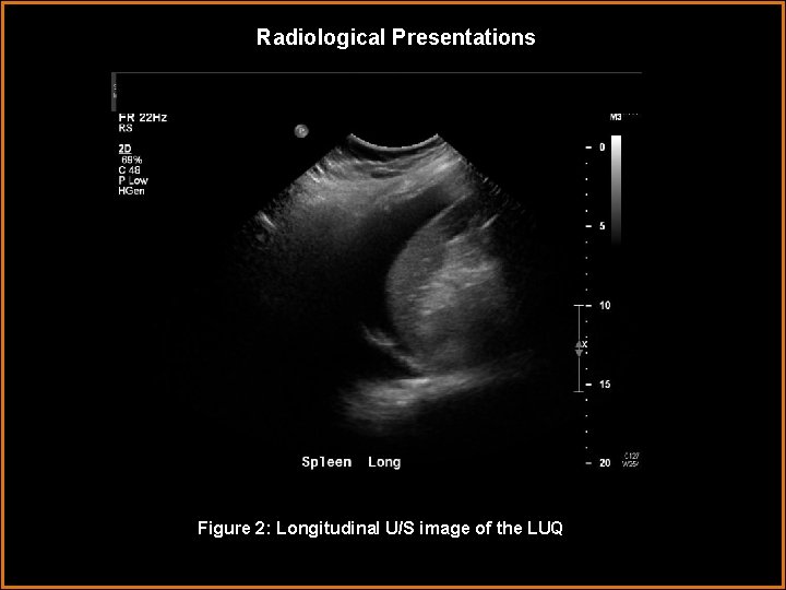 Radiological Presentations Figure 2: Longitudinal U/S image of the LUQL 