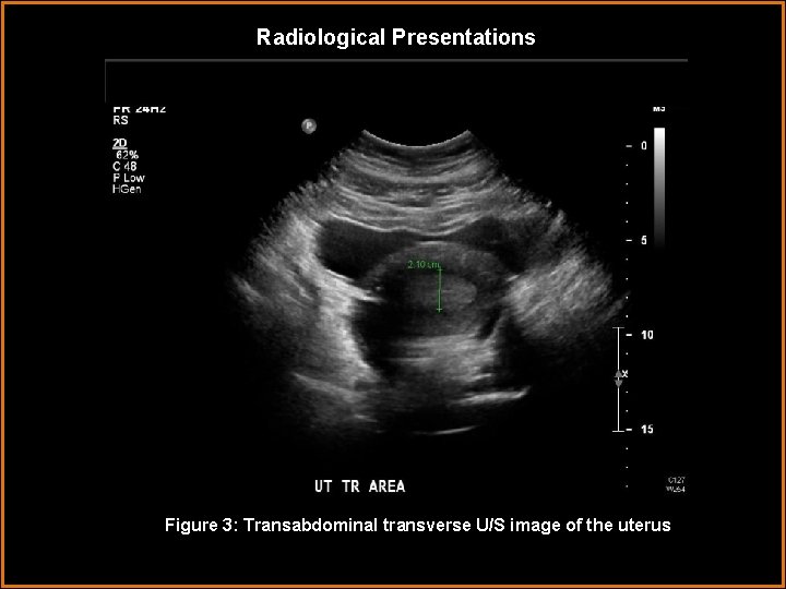 Radiological Presentations Figure 3: Transabdominal transverse U/S image of the uterus 