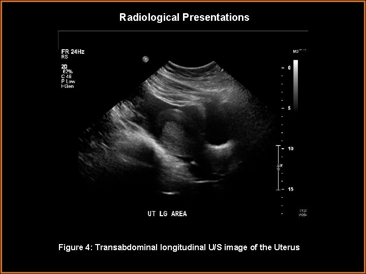 Radiological Presentations Figure 4: Transabdominal longitudinal U/S image of the Uterus 