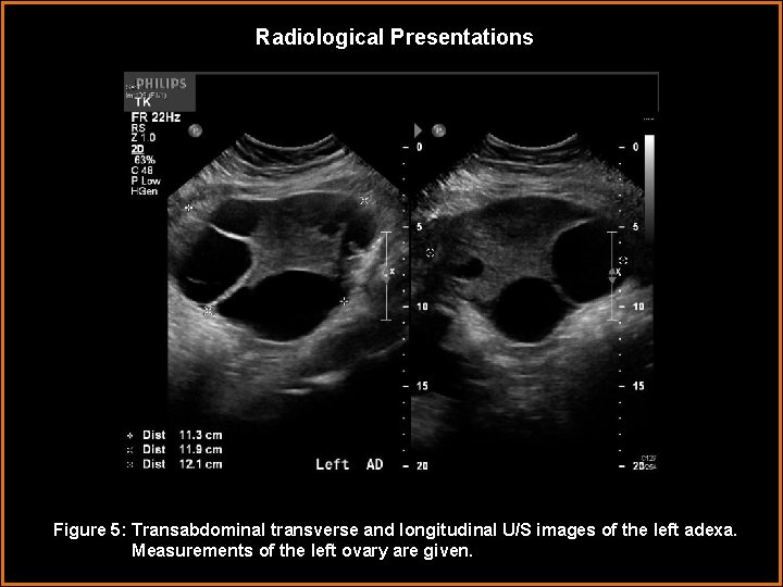 Radiological Presentations Figure 5: Transabdominal transverse and longitudinal U/S images of the left adexa.