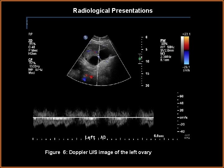 Radiological Presentations Figure 6: Doppler U/S image of the left ovary. L 