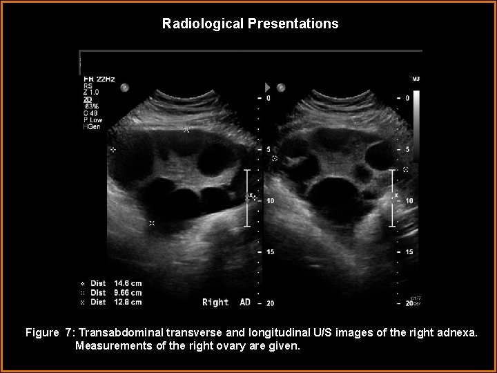 Radiological Presentations Figure 7: Transabdominal transverse and longitudinal U/S images of the right adnexa.