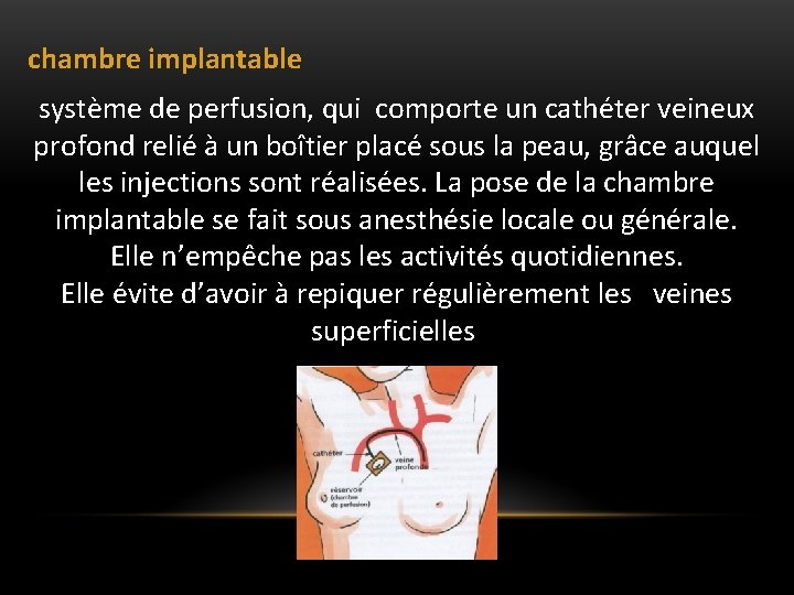  chambre implantable système de perfusion, qui comporte un cathéter veineux profond relié à