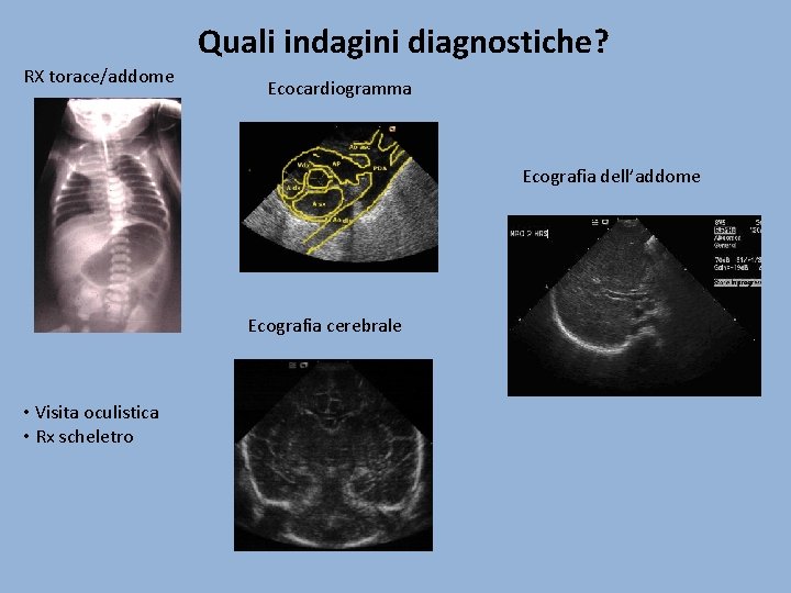 Quali indagini diagnostiche? RX torace/addome Ecocardiogramma Ecografia dell’addome Ecografia cerebrale • Visita oculistica •