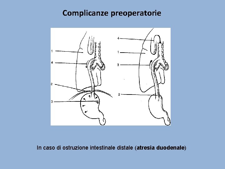 Complicanze preoperatorie In caso di ostruzione intestinale distale (atresia duodenale) 