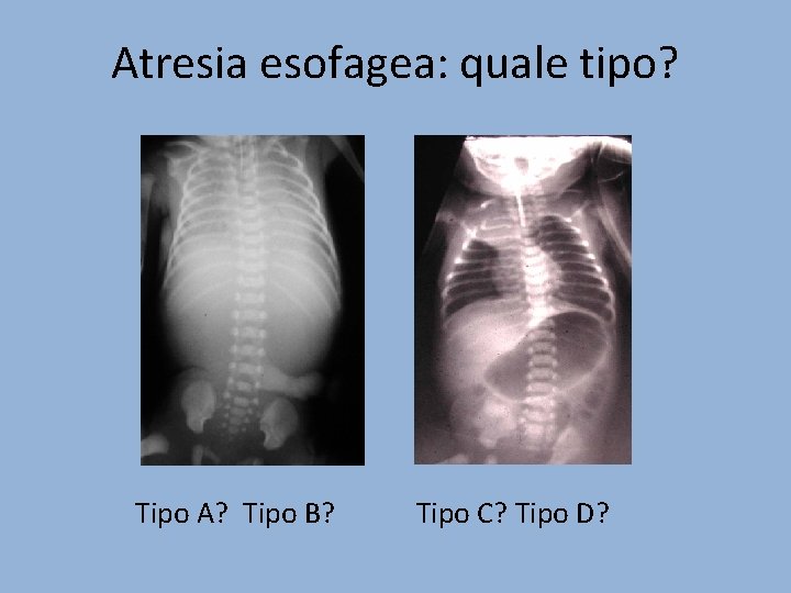 Atresia esofagea: quale tipo? Tipo A? Tipo B? Tipo C? Tipo D? 