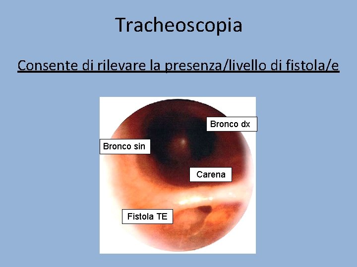 Tracheoscopia Consente di rilevare la presenza/livello di fistola/e Bronco dx Bronco sin Carena Fistola