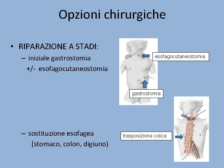 Opzioni chirurgiche • RIPARAZIONE A STADI: – iniziale gastrostomia +/- esofagocutaneostomia gastrostomia – sostituzione