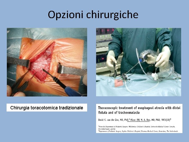 Opzioni chirurgiche Chirurgia toracotomica tradizionale 