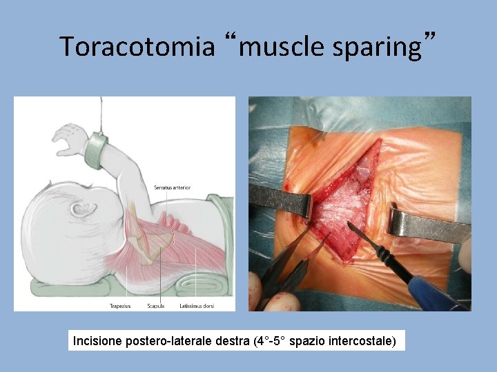 Toracotomia “muscle sparing” Incisione postero-laterale destra (4°-5° spazio intercostale) 