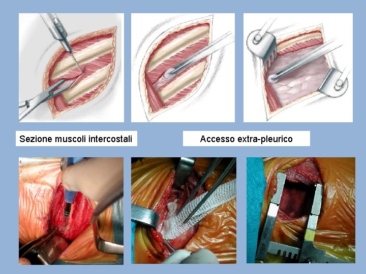 Sezione muscoli intercostali Accesso extra-pleurico 